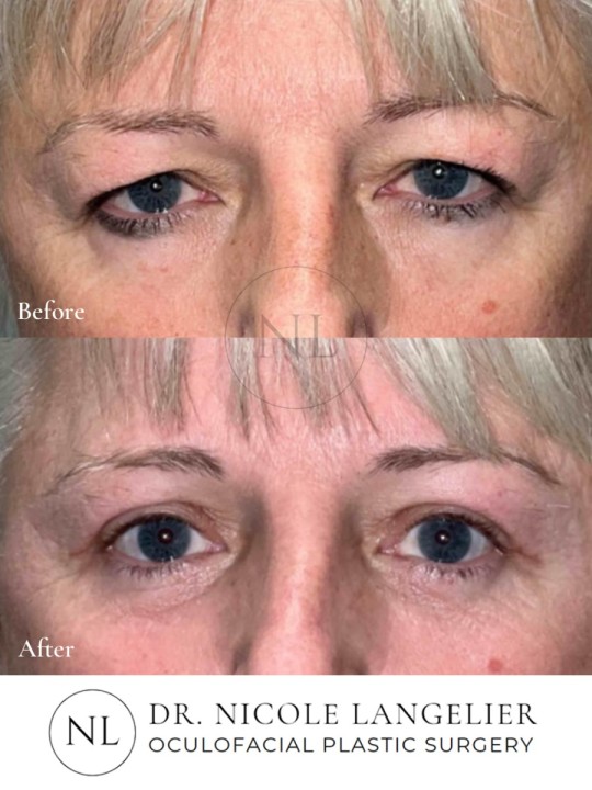 Lower Eyelid Blepharoplasty with Laser Resurfacing