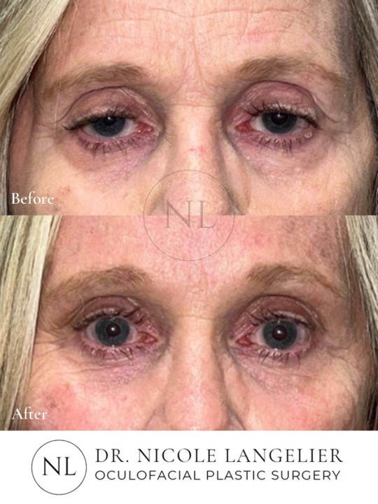 Full Face Laser Resurfacing