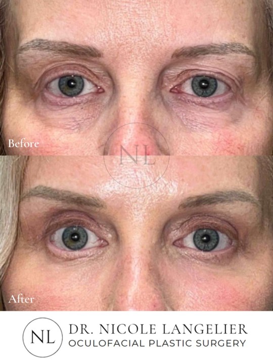 Lower Eyelid Laser Resurfacing
