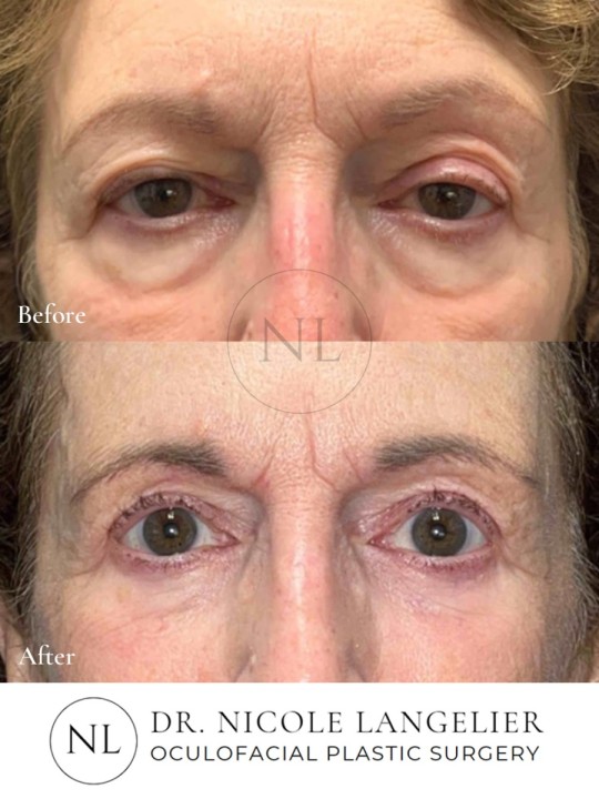 Lower Eyelid Laser Resurfacing
