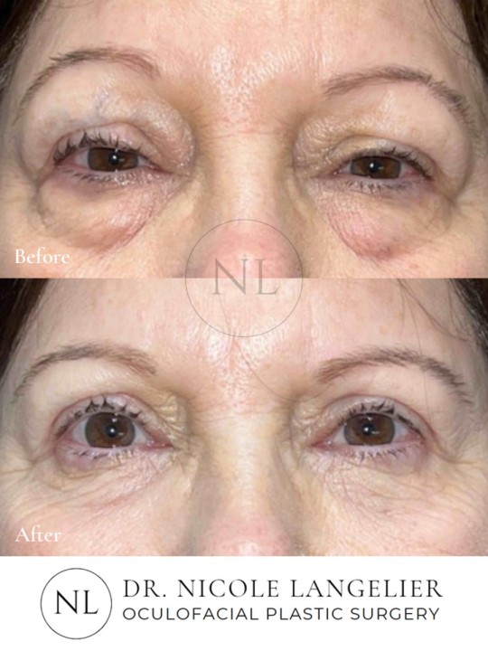 Lower Eyelid Laser Resurfacing