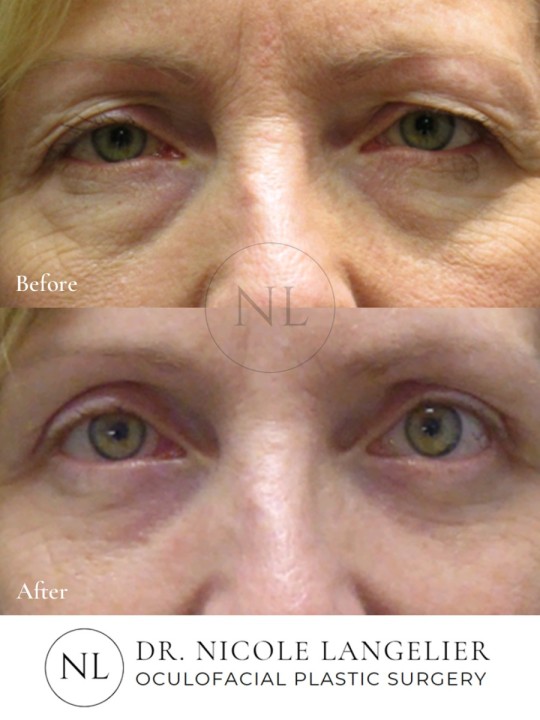 Lower Eyelid Laser Resurfacing