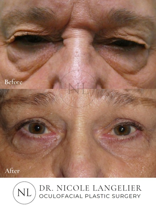 Lower Eyelid Laser Resurfacing