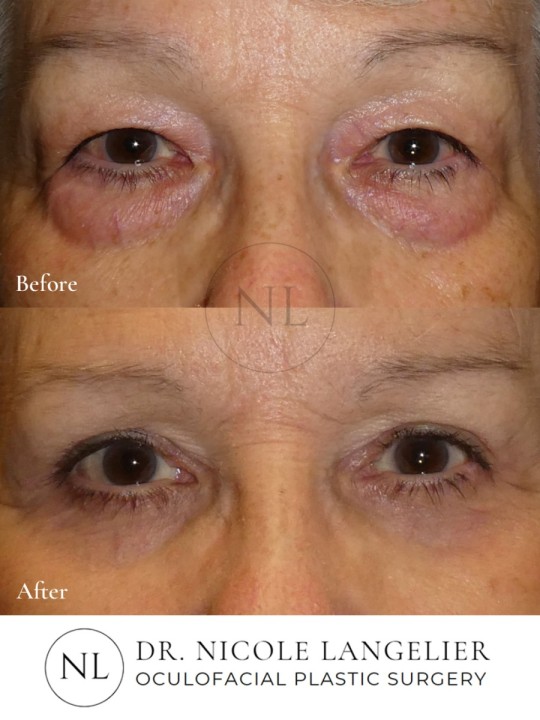 Lower Eyelid Laser Resurfacing