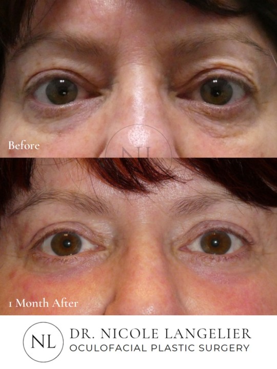 Lower Eyelid Laser Resurfacing