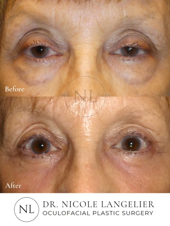 Lower Eyelid Laser Resurfacing