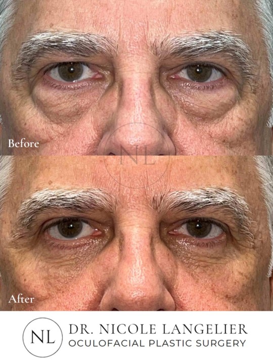 Men Lower Eyelid Blepharoplasty with Fat Transposition