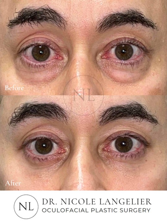Male Lower Eyelid Blepharoplasty