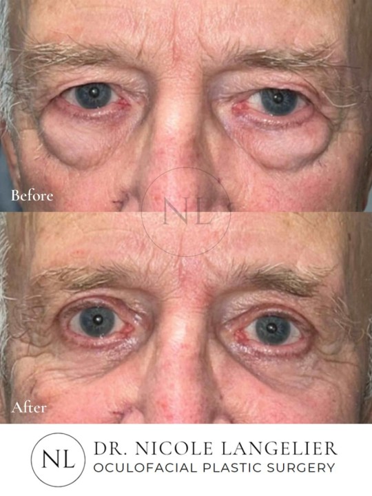Male Lower Eyelid Blepharoplasty