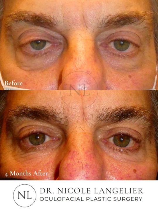 Male Lower Eyelid Blepharoplasty