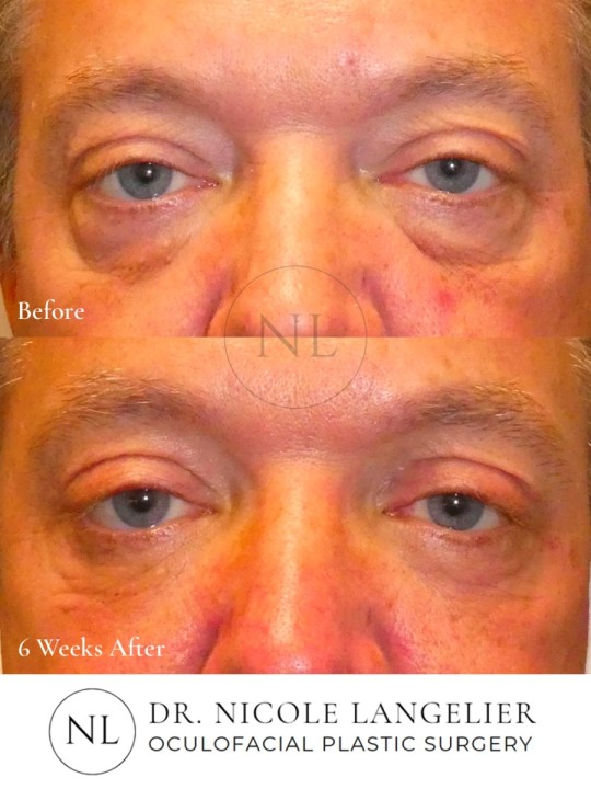 Male Lower Eyelid Blepharoplasty