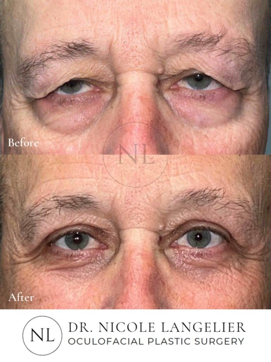 Male Lower Eyelid Blepharoplasty