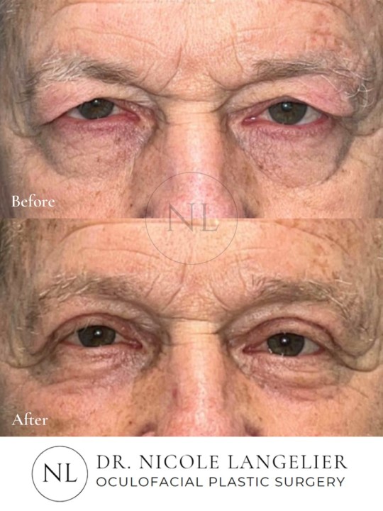 Male Lower Eyelid Blepharoplasty