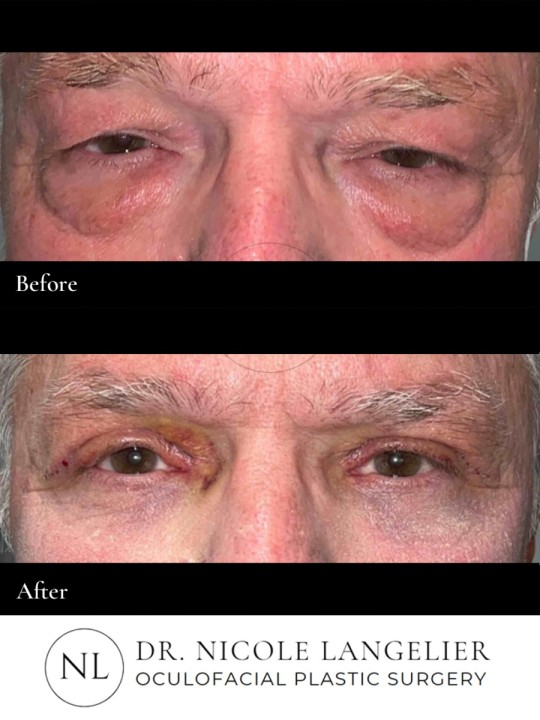 Male Lower Eyelid Blepharoplasty