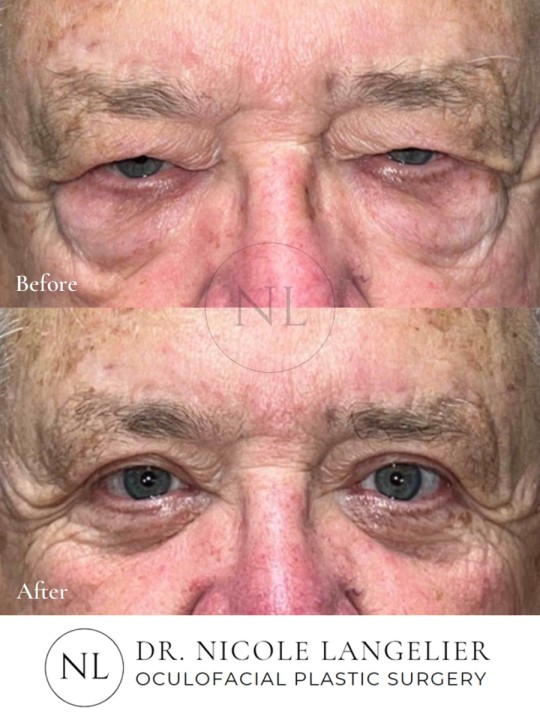 Male Lower Eyelid Blepharoplasty