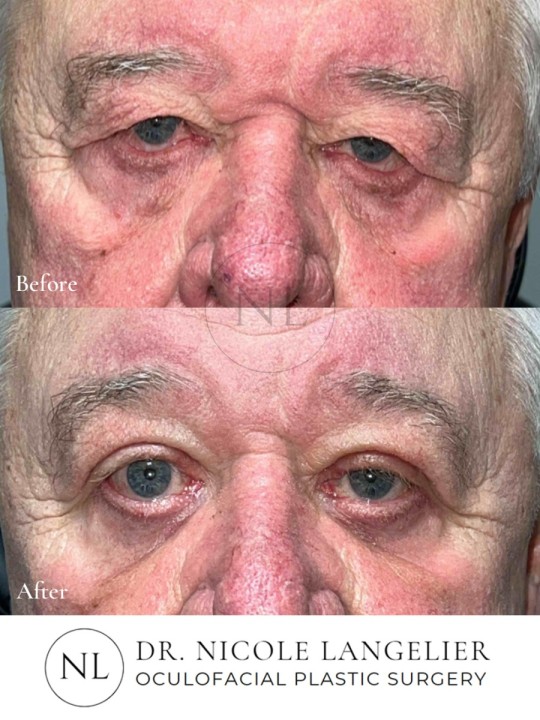 Male Lower Eyelid Blepharoplasty