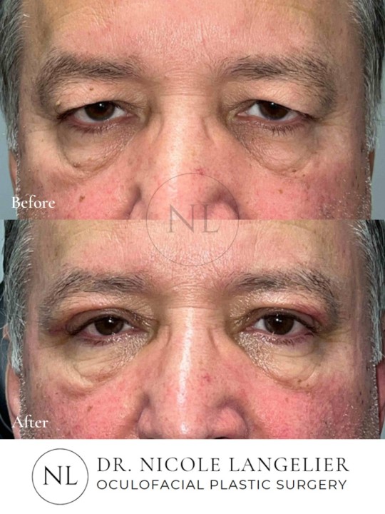 Male Upper Eyelid Blepharoplasty
