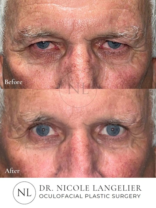 Male Upper Eyelid Blepharoplasty