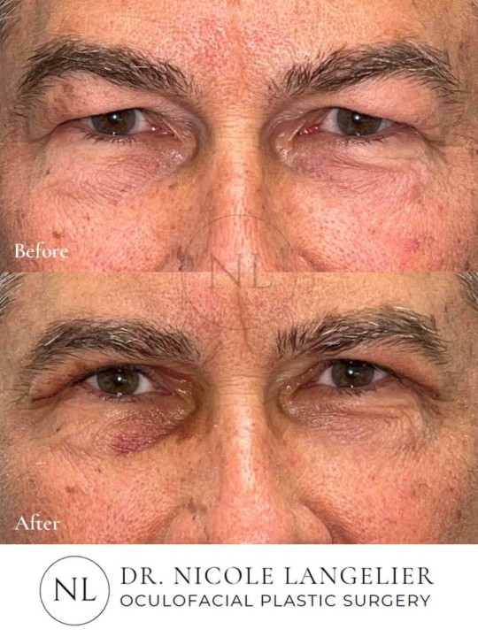 Male Upper Eyelid Blepharoplasty