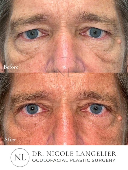 Male Upper Eyelid Blepharoplasty