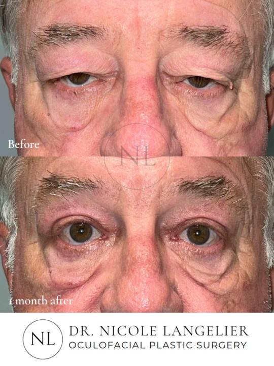 Male Upper Eyelid Blepharoplasty