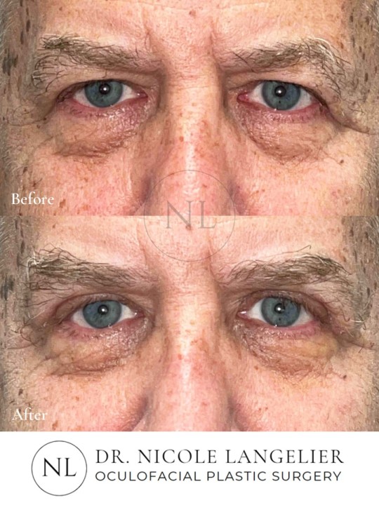 Male Upper Eyelid Blepharoplasty