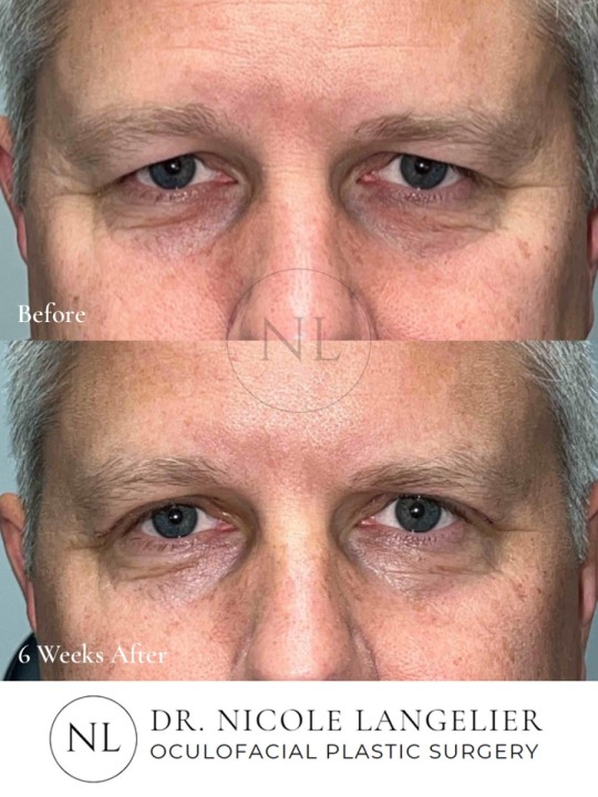 Male Upper Eyelid Blepharoplasty