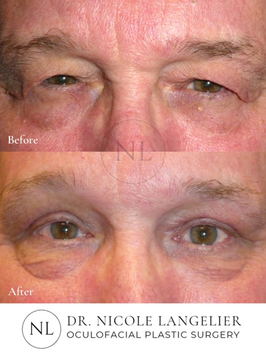 Male Upper Eyelid Blepharoplasty