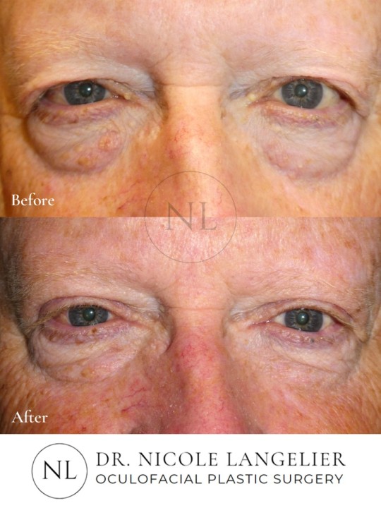 Male Upper Eyelid Blepharoplasty