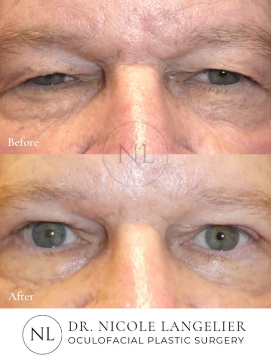 Male Upper Eyelid Blepharoplasty