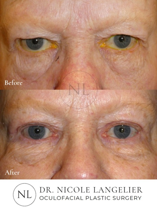 Male Upper Eyelid Blepharoplasty