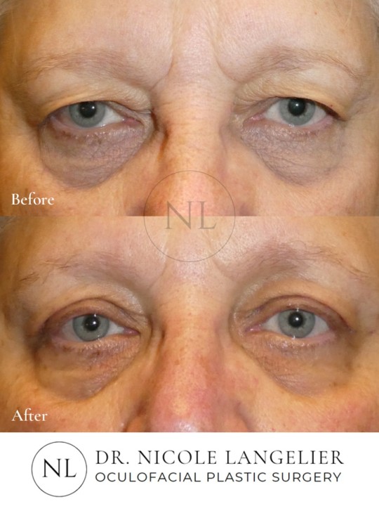 Male Upper Eyelid Blepharoplasty