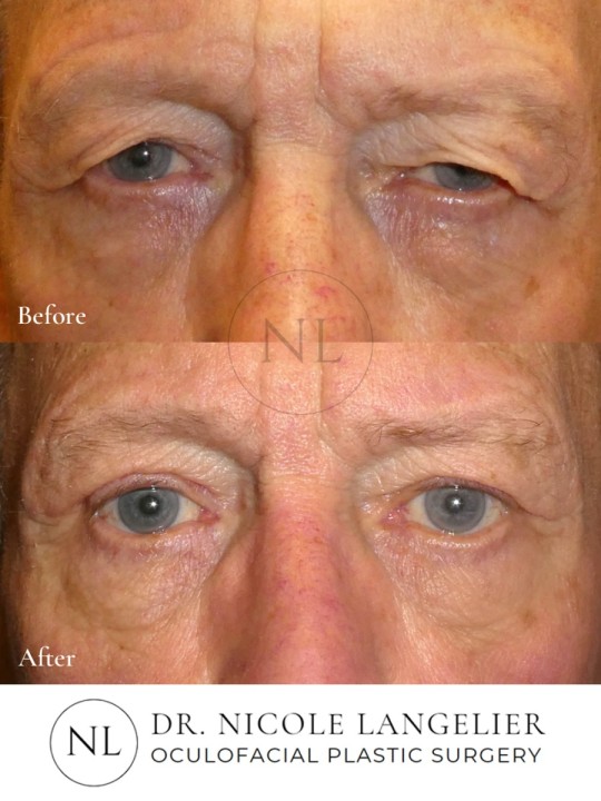 Male Upper Eyelid Blepharoplasty