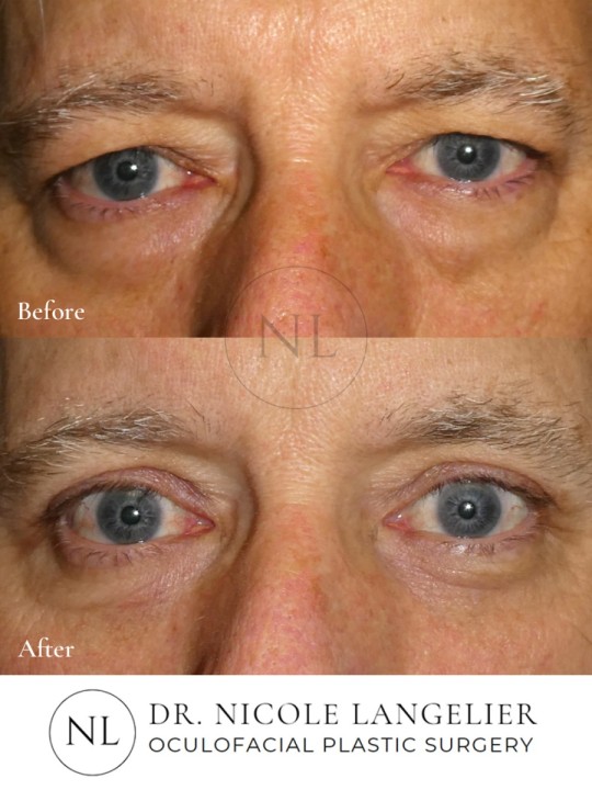 Male Upper Eyelid Blepharoplasty