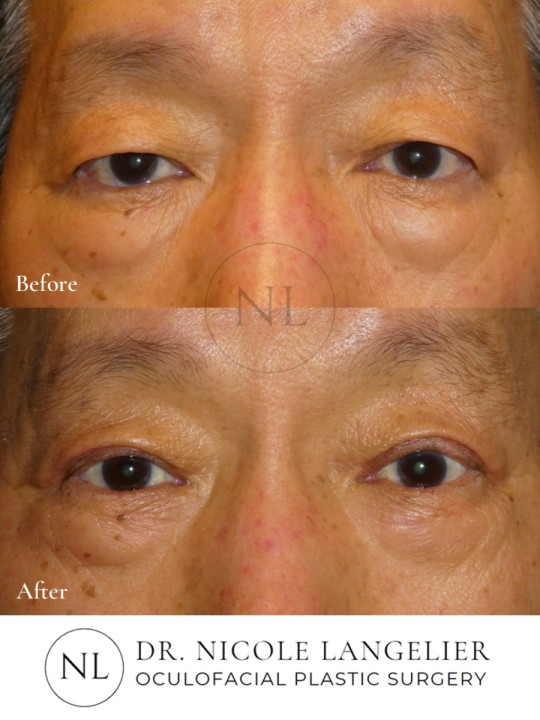 Male Upper Eyelid Blepharoplasty