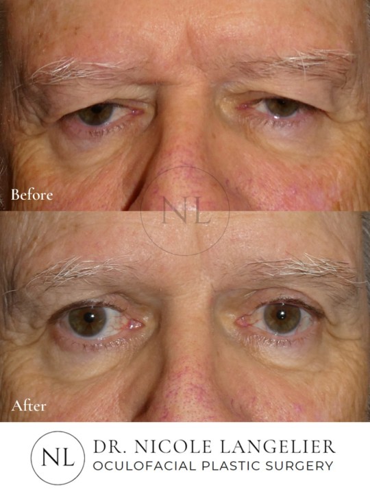 Male Upper Eyelid Blepharoplasty