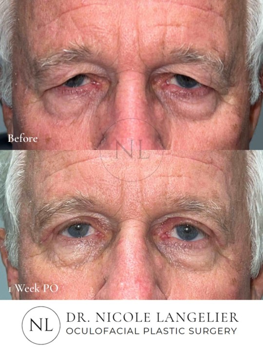 Male Upper Eyelid Blepharoplasty