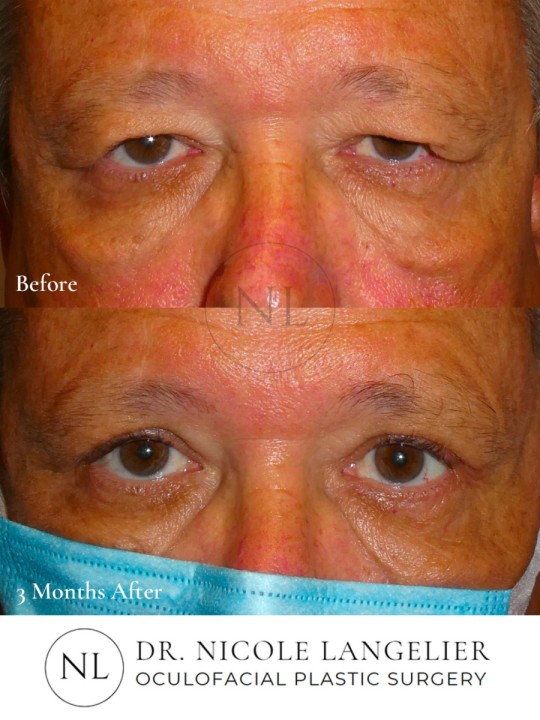 Bilateral Upper Eyelid Blepharoplasty