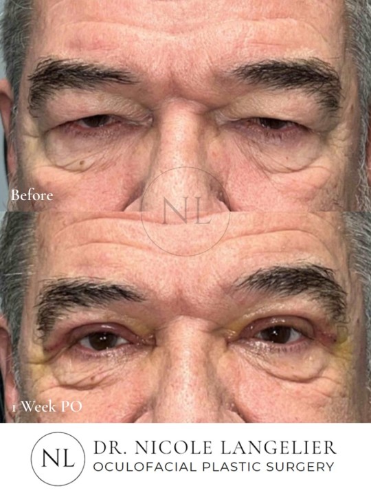 Male Upper Eyelid Blepharoplasty