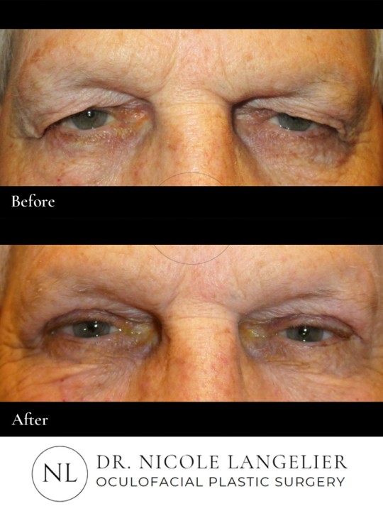 Male Upper Eyelid Blepharoplasty