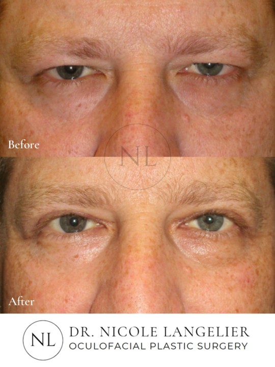 Male Upper Eyelid Blepharoplasty