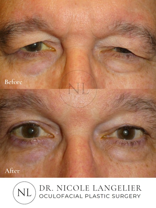 Male Upper Eyelid Blepharoplasty