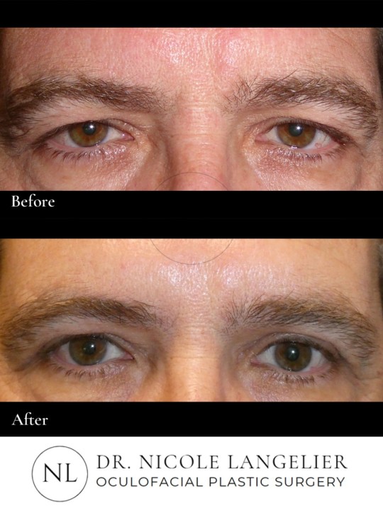 Male Upper Eyelid Blepharoplasty