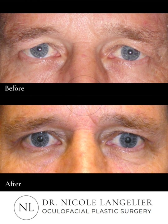 Male Upper Eyelid Blepharoplasty