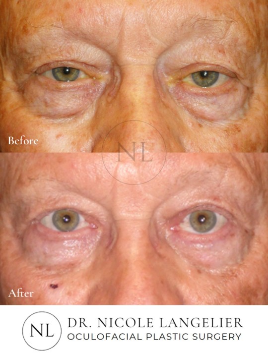 Male Upper Eyelid Blepharoplasty