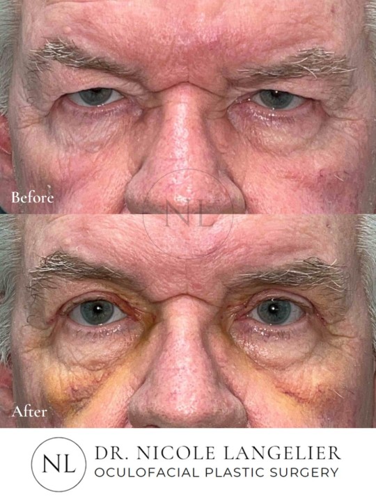 Male Upper Eyelid Blepharoplasty