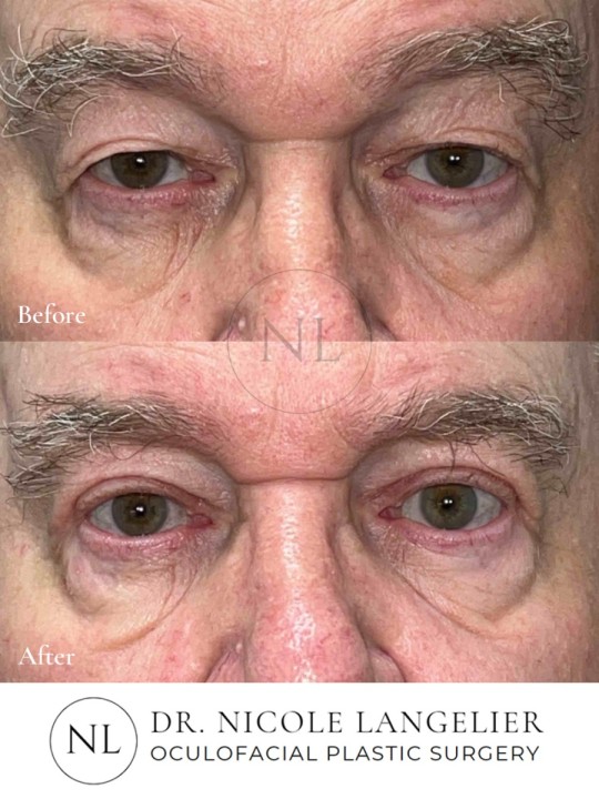 Male Upper Eyelid Blepharoplasty