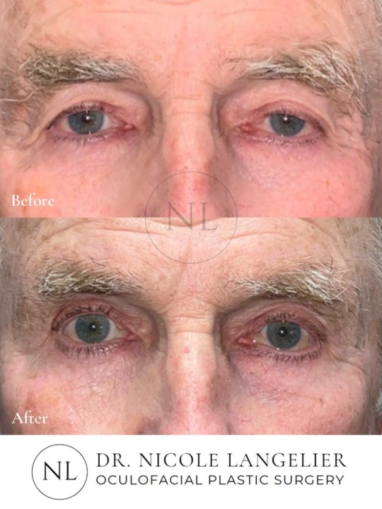 Male Upper Eyelid Blepharoplasty