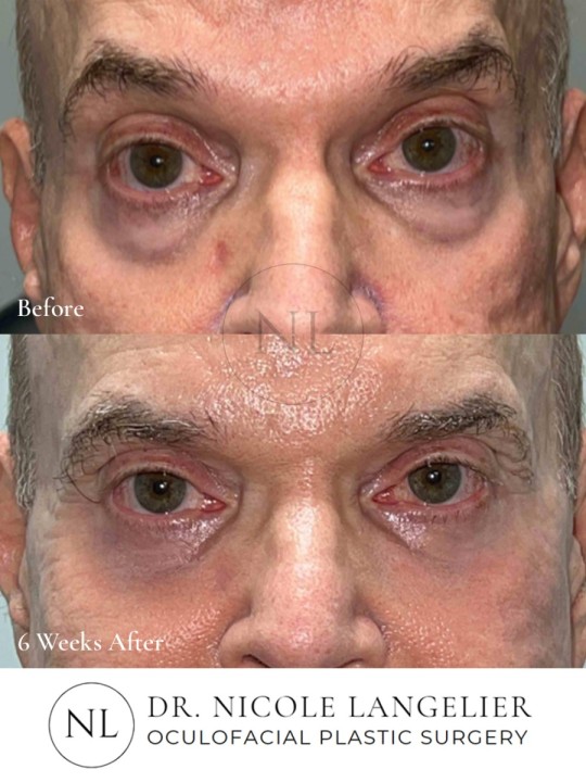 Male Upper & Lower Eyelid Blepharoplasty