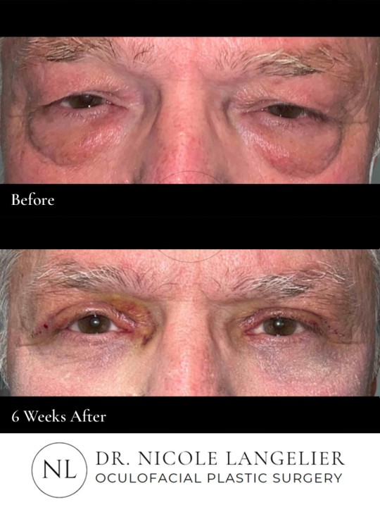 Male Upper & Lower Eyelid Blepharoplasty